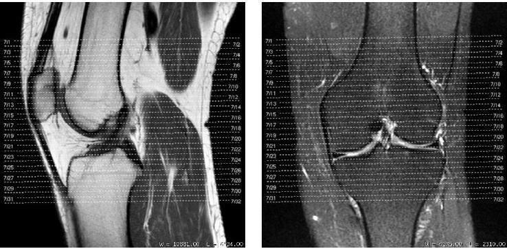 Joelho Sagital T1/DP (Fotografar) Sagital T2 Fat (Fotografar) Axial T2 Fat (Fotografar) Coronal T2 Fat (Fotografar) Coronal T2 Oblíquo Contraste (se necessário) Sagital T1 Fat Axial T1