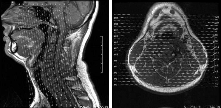 - Coronal: 51 / 77 Programar a sequência sobre o