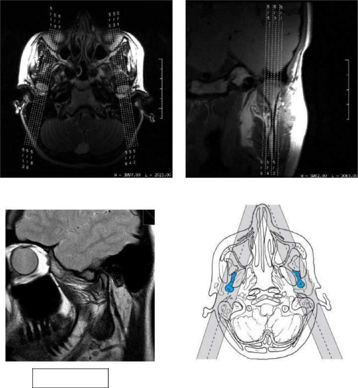 ATM Coronal T1/DP (Boca Fechada) Sagital T1/DP (Boca Fechada) Sagital T2 Fat (Boca Fechada) Dinâmico Sagital T1/DP (Boca Aberta) Programação ATM 52 / 77 -