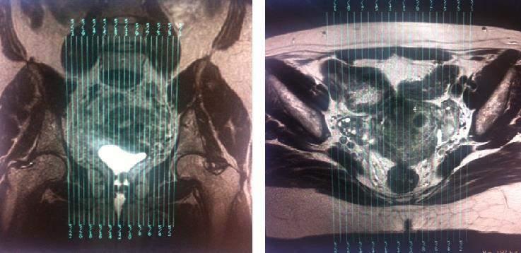 - Sagital: Programar nos planos coronal e axial