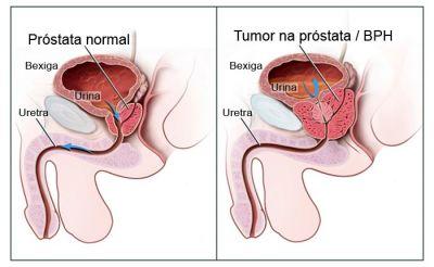 7. Próstata É do tamanho de uma castanha, envolve a uretra como um anel, secreta um líquido esbranquiçado rico