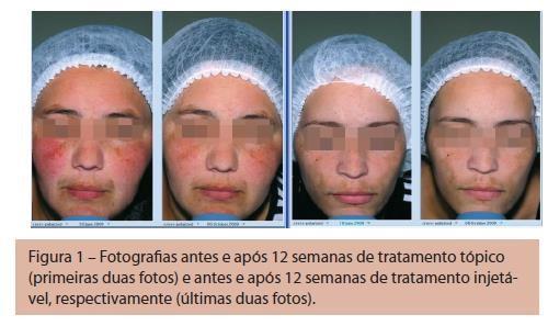 Como efeitos colaterais foram apontados eritema, equimose e ardência local, e as pacientes toleraram o tratamento.