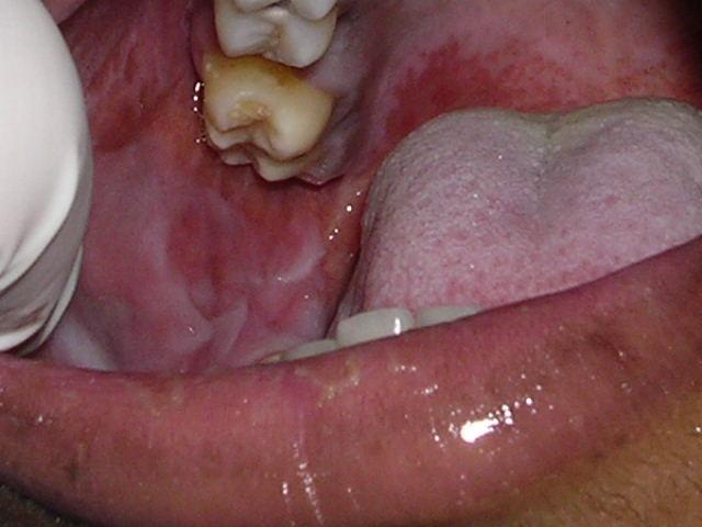 lingual, fórnix, bordo lateral de língua, pilares palatinos, palato, assoalho de boca, petéquias, pseudomembranas