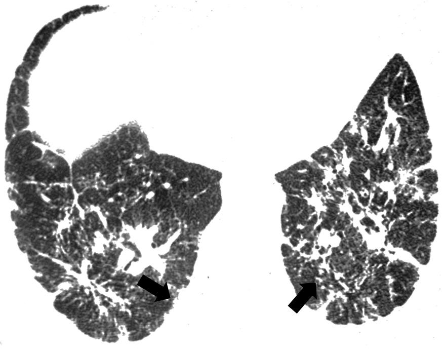 Imagem de TCAR do tórax em janela de pulmão no plano axial evidenciando opacidades reticulares esparsas com bronquiolectasias de tração, destacando-se importante acometimento do feixe