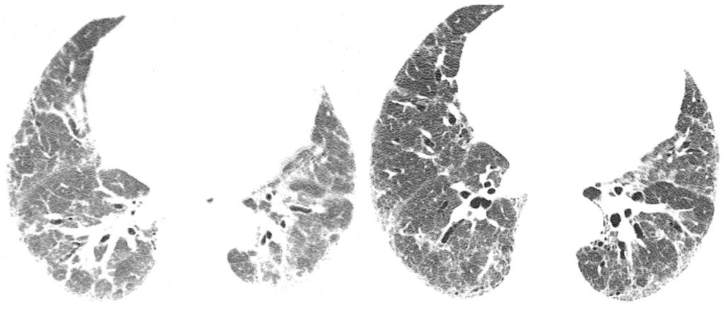 Pneumonia intersticial usual: padrões típico, possível e inconsistente A B Figura 6. Imagens axiais de TC do tórax em janela de pulmão.
