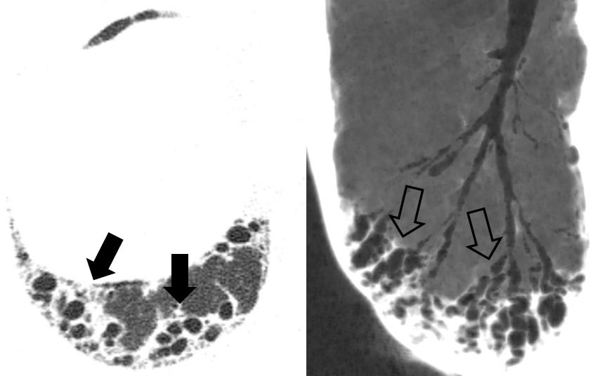 adequados. A B A B Figura 7. Imagem axial de TCAR em janela pulmonar (em A) e reformatação em projeção de intensidade mínima (em B).