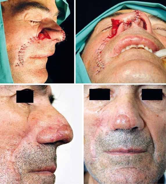 Fig. 2 - Aspecto após transposição do retalho interpolado do sulco melolabial direito para o defeito cirúrgico nasal, e encerramento directo do defeito secundário resultante (imagens superiores);