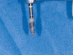 um implante com L-PRF antes da inserção.