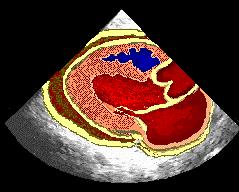 derrame pericárdico evidenciado no ecocardiograma EXAMES LABORATORIAIS hemograma, VHS marcadores do dano miocárdico PPD, isolamento de BAAR, ADA hemoculturas, culturas de outros materiais biológicos