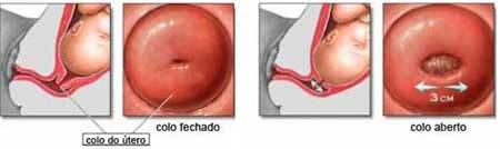 Exame Especular É importante para verificar presença de lesões cervicais ou vaginais.