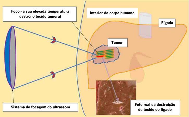 Ultrassom focalizado de alta intensidade A