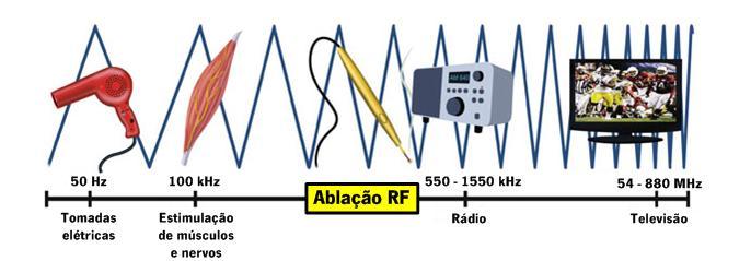 Ablação por radiofrequência Utiliza corrente alternada (AC) a uma frequência de 375-480 khz para destruir tecido tumoral.