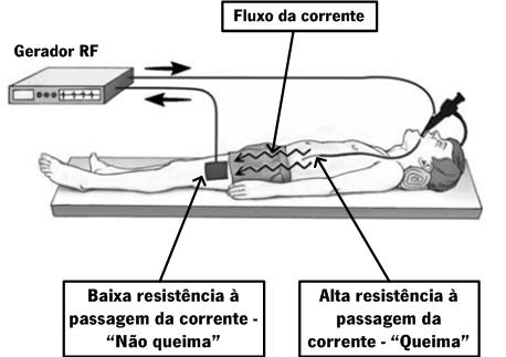 Envolve grande parte do corpo do paciente. Maior risco de queimaduras.