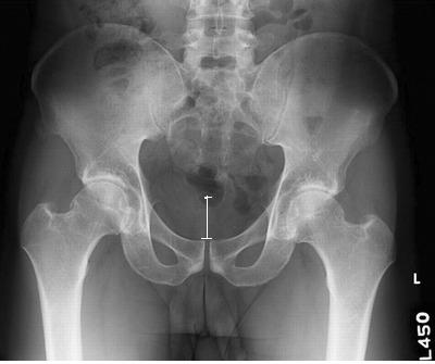 axis of the left, resulting in between 0.56 and 1.8 acceptable for measurement of acetabular landmarks [39].