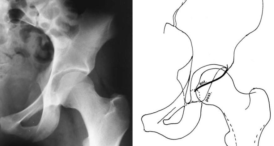 signs: (crossover sign) suggesting a partial over-coverage, the posterior ischial spine, which denotes acetabular retroversion and posterior wall sign, suggesting deficiency of rear cover.