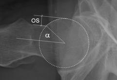 Lequesne's false profile view was measured above the angle of coverage (VCA) described by Lequesne and de Seze, and observed the possible decreased of the posterior-inferior joint space or even the