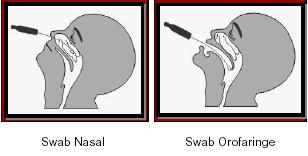 COLETA DE SWAB NASAL / ORAL COMBINADO: Coletar três swabs, um de orofaringe e dois de nasofaringe; Realizar a coleta com a fricção do swab na região posterior do meato nasal utilizando um swab para