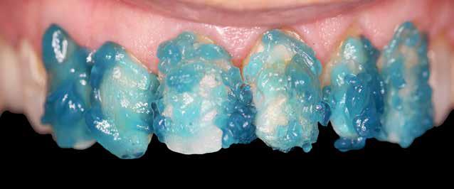 444 Figura 12 Aplicação de ácido fosfórico nos dentes para condicionamento. Figura 13 Aplicação de adesivos nos dentes.
