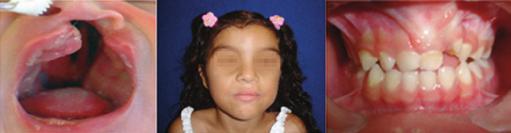 Pereira RMR et al. 4 anos de idade, avaliando o grau de comprometimento deixado pelas cirurgias primária do lábio e do palato sobre a maxila das crianças com FTIU.