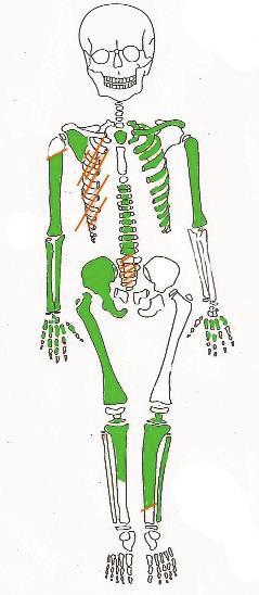 2 Representação do estado de preservação do esqueleto do indivíduo 678