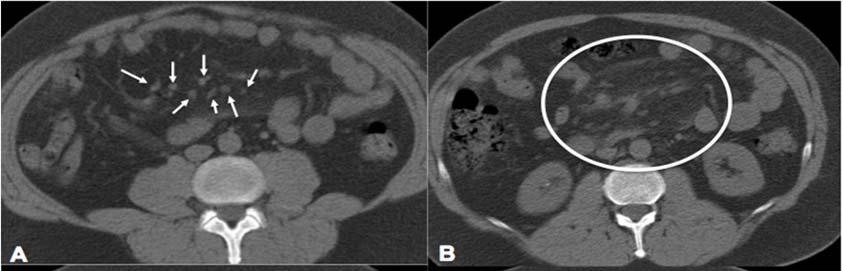 Figura 1 Cortes axiais de tomografia computadorizada sem contraste evidenciando em A e D (setas) pequenos nódulos e em B e C (circunscrito) espessamento da gordura mesentérica com aspecto em halo.