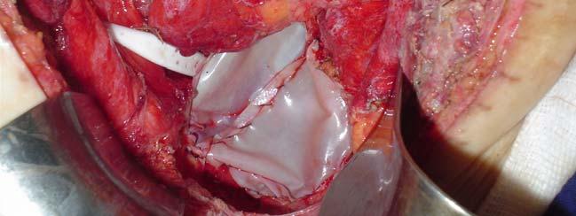 Reimplante de ureteres Figura 4: Amputação