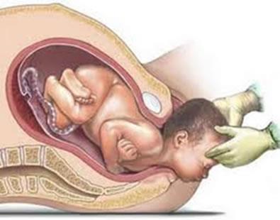 PARTO NORMAL Parto normal O parto normal é o desfecho natural de uma gravidez, de início espontâneo, baixo risco, durante todo o processo, pois é um tipo de parto cuja recuperação é mais rápida e que
