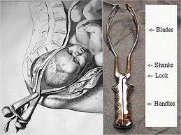 Parto a fórceps É o parto via vaginal (parto normal) no qual se utiliza um instrumento cirúrgico semelhante a uma colher que é colocado no canal