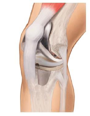 Para realização do procedimento cirúrgico de substituição articular do joelho, sugere-se a técnica descrita abaixo: Considerações pré-operatórias As ressecções ósseas femoral e tibial são feitas com