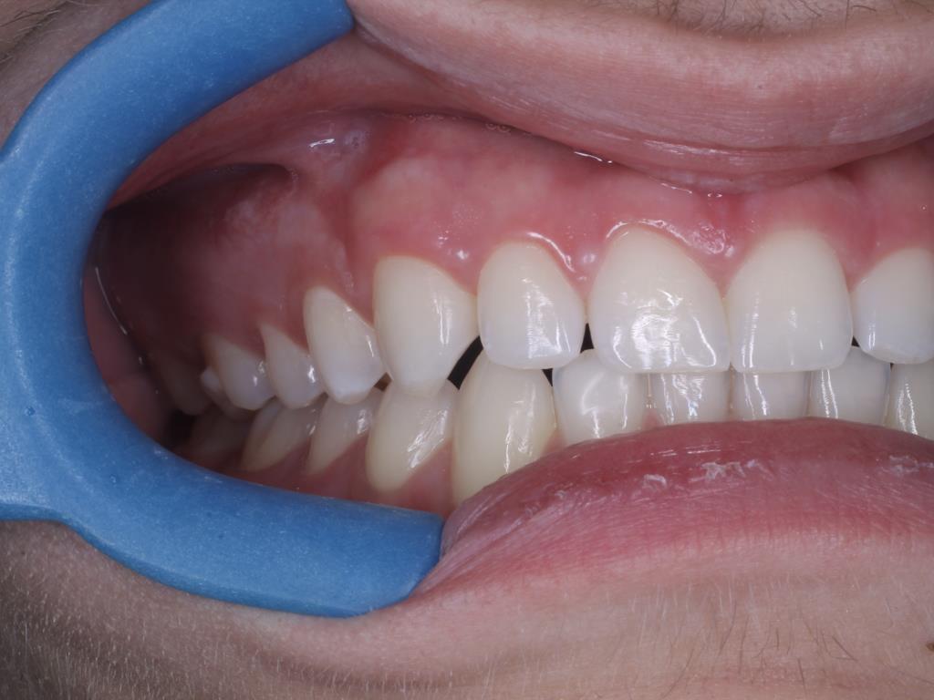 64 forma a deixar um contato muito suave entre estes dentes, sem o paciente se queixar de desconforto na oclusão ou