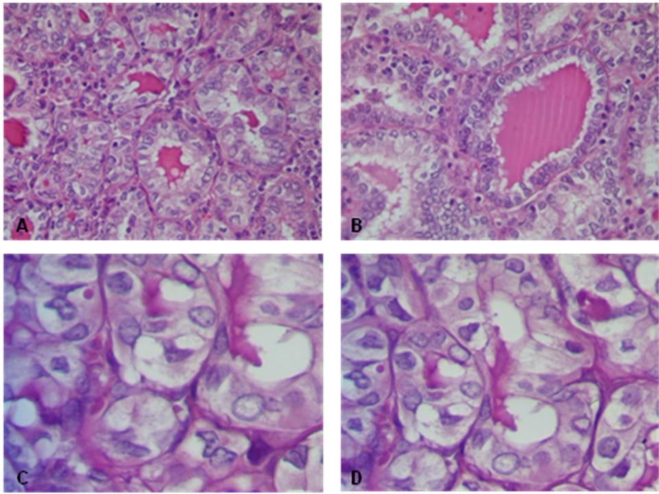 14 Figura 2 - Carcinoma papilífero, variante folicular Legenda: A e B: Notar predomínio de folículos (HE-100x); C e D: Núcleos de aparência vazia (HE-400x) FONTE: Fotos da Autora Estruturas papilares