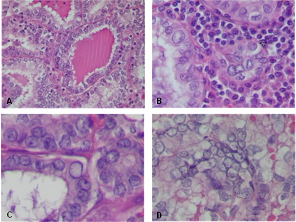 16 Figura 4 - Carcinoma papilífero Legenda: A e B: Notar aspecto vazio ou em vidro fosco do núcleo, com cromatina rarefeita na parte central (HE-100x, 400x, 400x); C e D: Sobreposição dos núcleos com