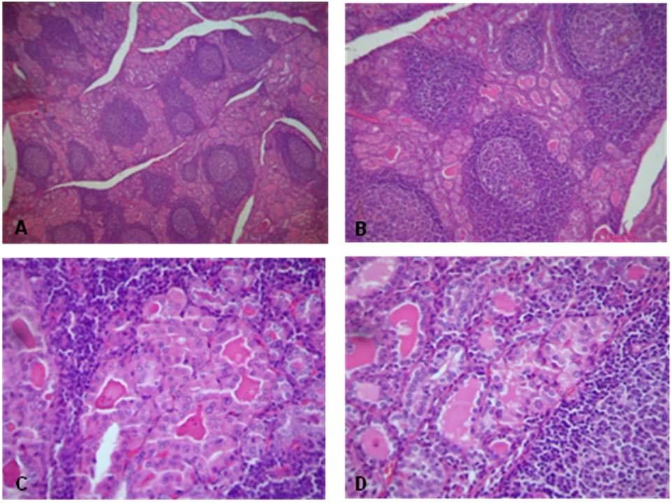 27 1.2.6 Aspectos histopatológicos As características histológicas da tireoidite de Hashimoto incluem atrofia dos folículos tireoidianos com metaplasia oncocítica (células de Hürthle) do epitélio