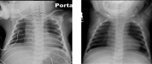 17. Na angiografia, o aspecto de pescoço de ganso é característico de (A) defeito do septo atrioventricular. (B) CIV perimembranosa. (C) janela aorto pulmonar. (D) Truncus arteriosus.