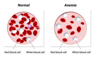 Anemias causadas por hemorragias: Hemorragia é a perda de sangue, com diminuição da volemia e perda dos elementos figurados e líquidos do sangue.