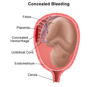 Descolamento prematuro da placenta É definida como a