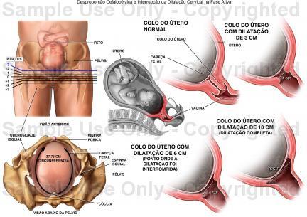 Desproporção céfalo-pélvica A relação do tamanho do feto com a pelve materna é de grande importância, quando o polo céfálico não