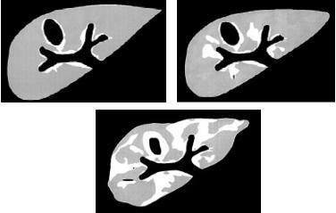 A B C C Figura 2 Diferentes padrões de fibrose periportal: A Padrão D (fibrose periportal central), B Padrão E (fibrose periportal avançada com manchas