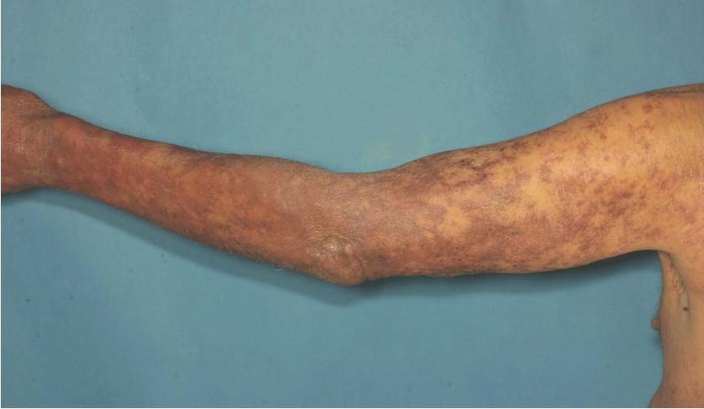 Figura 3. Placas castanho-reticulares no braço esquerdo Referências 1 2 3 4 Jain S, Sehgal VN. Multidrug therapeutic challenges in leprosy. Int J Dermatol. 1997;36:493-6 Water MF.