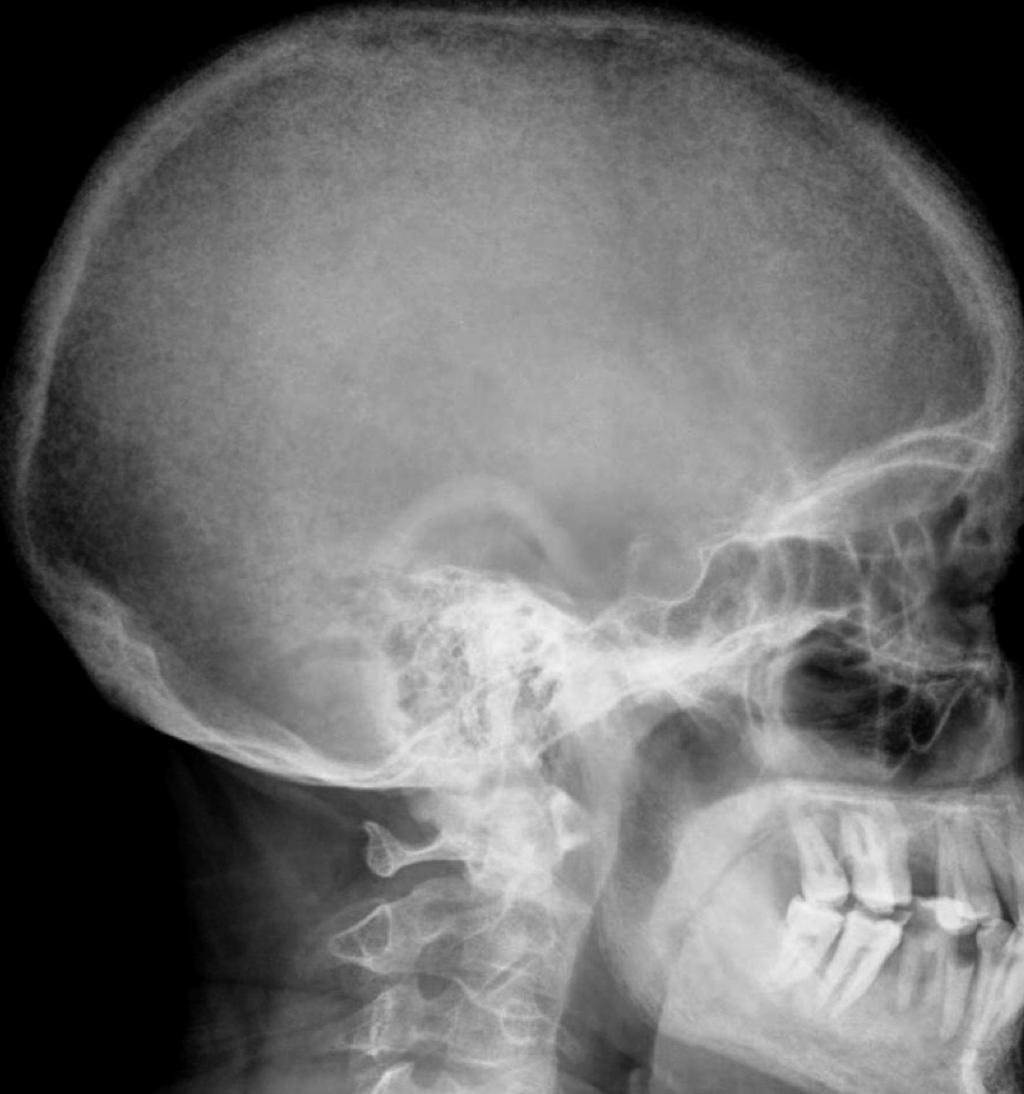 Fig. 8 - Reabsorção da extremidade acromial da clavícula: Radiografias anteroposteriores dos ombros em dois doentes com