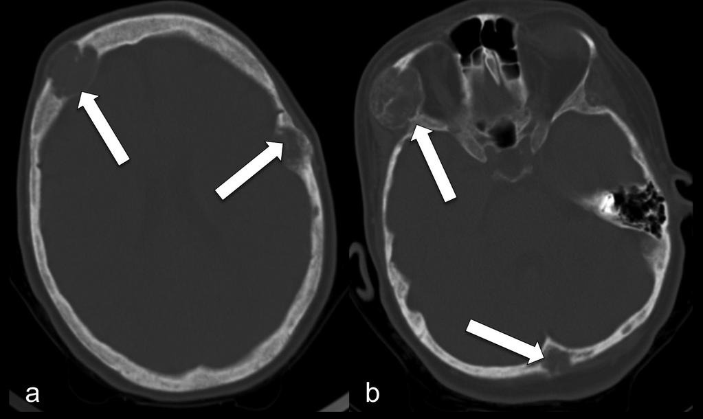 10 - Tumores castanhos da calote craniana e das paredes orbitarias: Imagem axial de TC revela presença de múltiplas