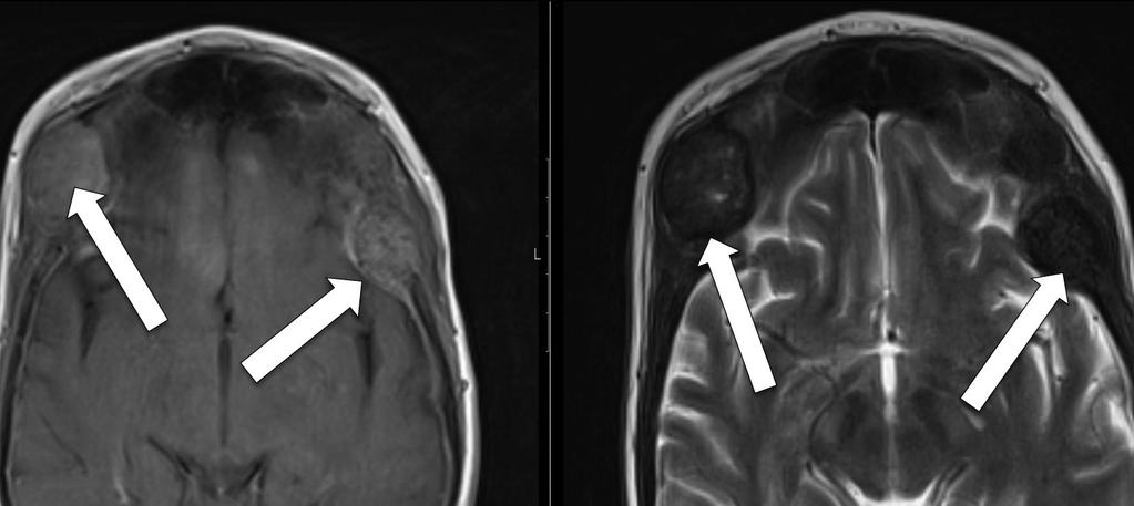 7 - Reabsorção cortical subperiosteal: A reabsorção subperiosteal é geralmente bem evidente em radiografias das mãos,