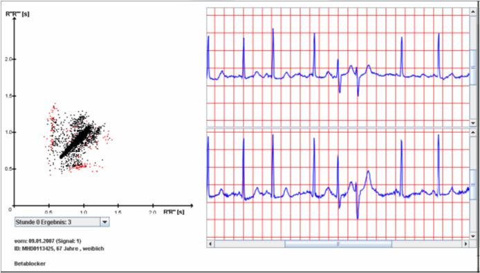 Benefícios de uma combinação entre. Holter e SRA Holters são baseados no controle do ritmo VES Couplets Bigemini, Trigemini Taquicardia Bradicardia.
