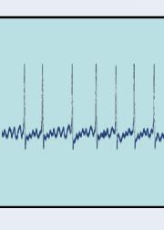 Solução necessária para o Diagnóstico Gravando ECG Preparação dos dados Análise Relatório 1:NN=850ms 2:NN=725ms