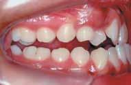 aberta posterior bilateral, apinhamento dentário superior e inferior, com