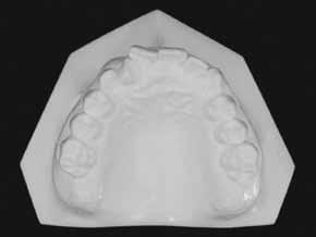 retrusão maxilar (WITS = -7mm; ANB = -2, com SNA = 75 e SNB = 77 ),