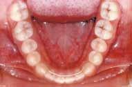 oclusão da paciente se encontra bem estabelecida, com preservação das relações de molares e