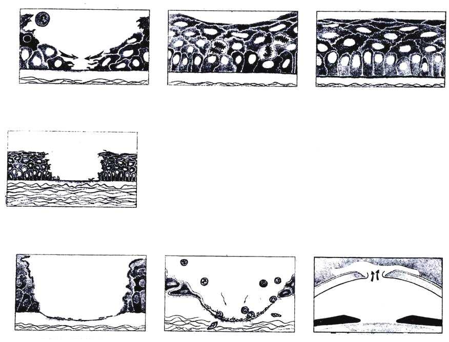 edu) humor aquoso ETIOLOGIA Trauma CERATITE ULCERATIVA Ceratoconjuntivite seca / cinomose Anormalidades de cílios / pálpebras Corpos estranhos Queimaduras químicas CERATITE ULCERATIVA SINAIS CLÍNICOS