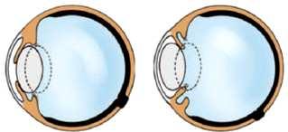 SINAIS CLÍNICOS Opacidade do cristalino, em graus variáveis, podendo haver déficit visual parcial ou total, dependendo do estágio de