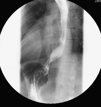 para o estudo. 13 pacientes foram excluídos, pois apresentavam metaplasia intestinal em extensão inferior a 1cm.